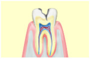 虫歯のサイン