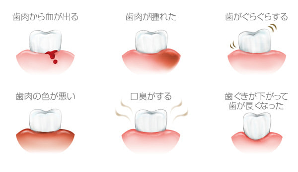 歯周病のサイン