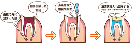 根管治療