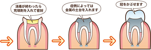 根管治療