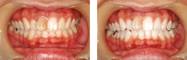 ホワイトニング症例
