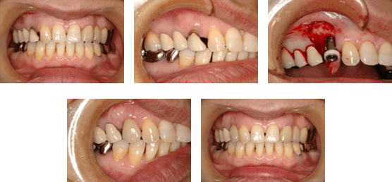 インプラント症例　前歯