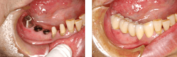 インプラント症例　奥歯