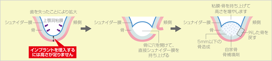 サイナスリフト