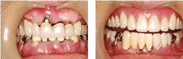 義歯(入れ歯)症例