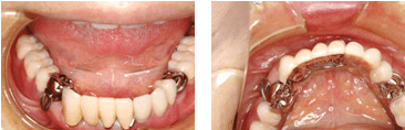 義歯(入れ歯)症例